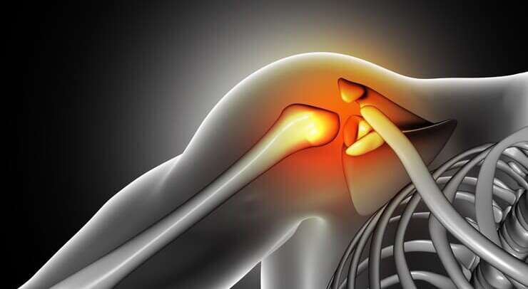 Dor no Ombro: causas comuns e tratamentos